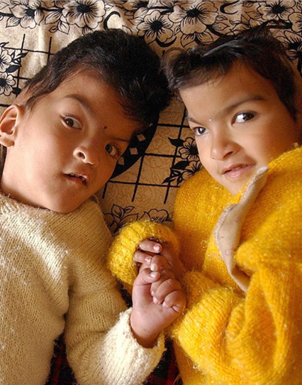 Successful surgery on conjoined twins